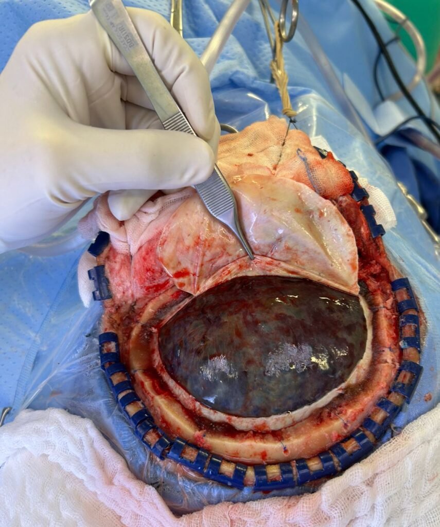 Hematoma subdural subagudo