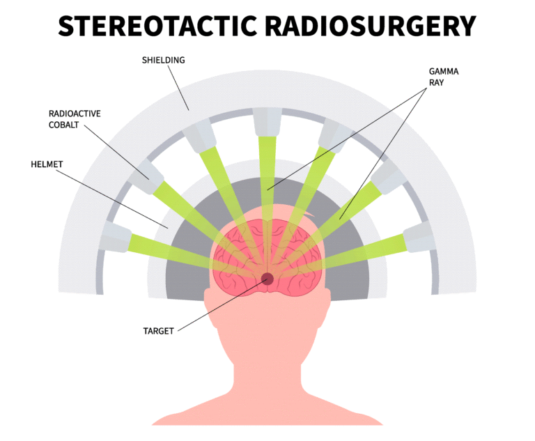 Radiocirugía estereotáctica: ¿Qué es y cuándo es necesaria en pacientes?