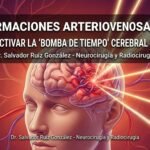 Malformaciones Arteriovenosas (MAV): Cómo Desactivar la “Bomba de Tiempo” Cerebral sin Cirugía