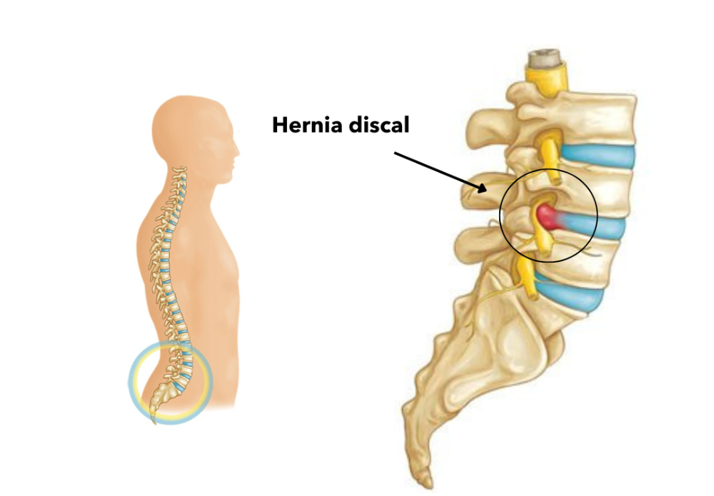 Diagnóstico y tipos de hernia discal cervical y lumbar — neurocirugía Médica Sur