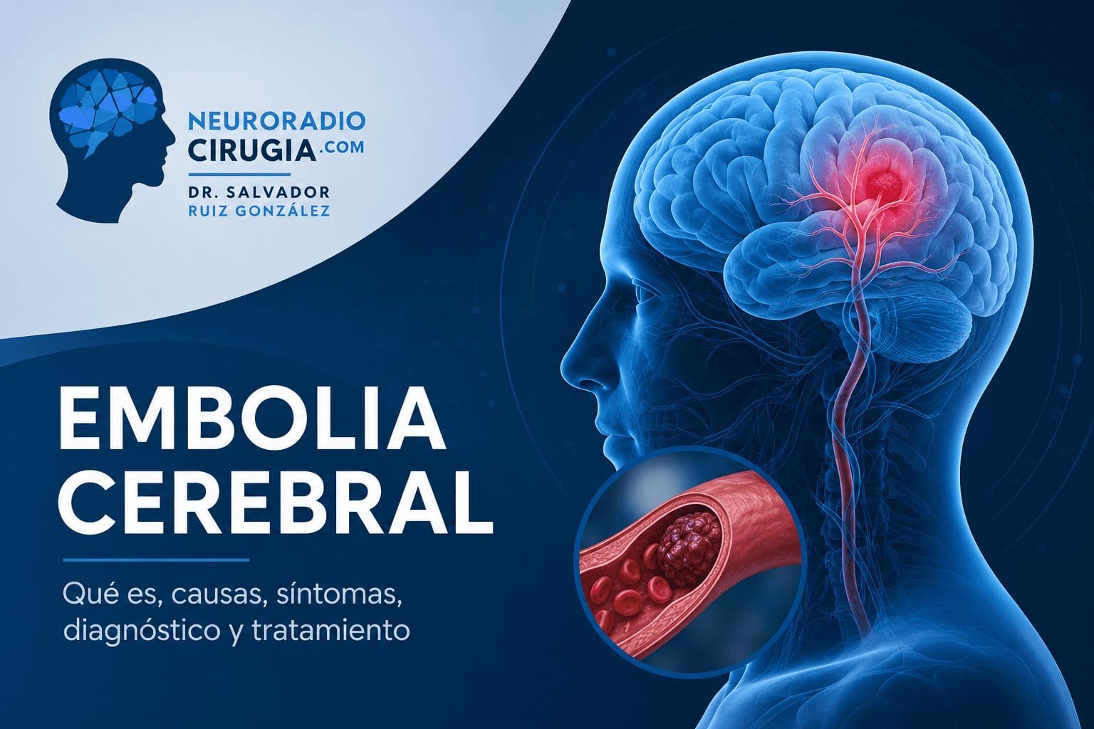 Imagen médica sobre embolia cerebral, síntomas, tratamiento y recuperación tras un EVC.