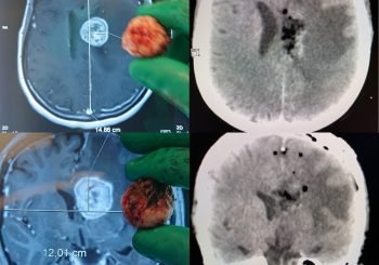 Foto seccion neurooncologia